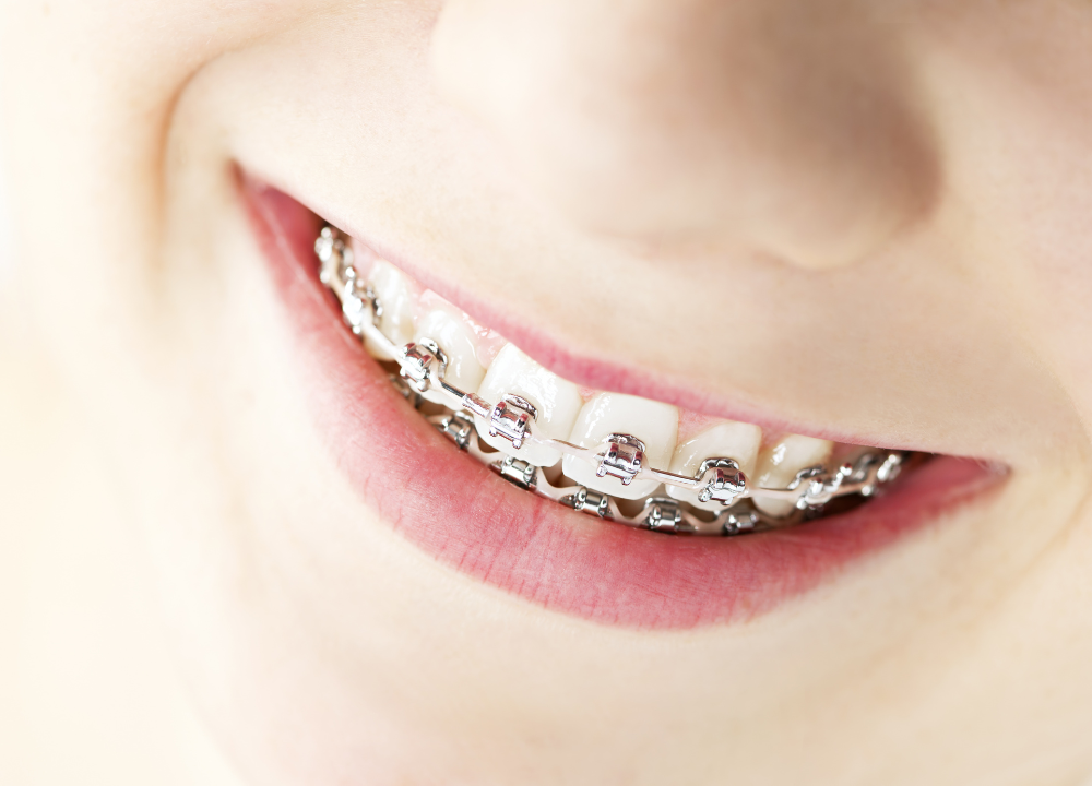 Silver Smiles: Unraveling the Mystery of Kids' Silver Teeth